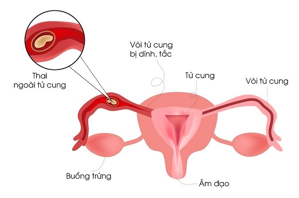 Chửa ngoài tử cung: Phát hiện và hướng điều trị