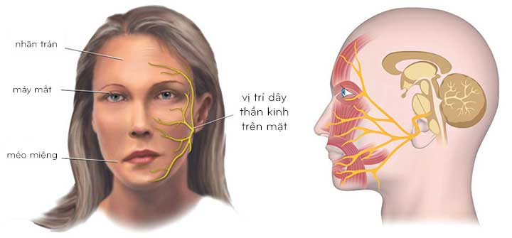 Tìm hiểu về liệt dây thần kinh số 7 ngoại biên: Triệu chứng, nguyên nhân, điều trị và phòng bệnh