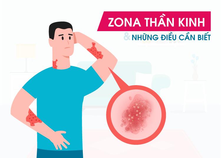 Zona thần kinh: Nguyên nhân, triệu chứng, cách điều trị và phòng bệnh